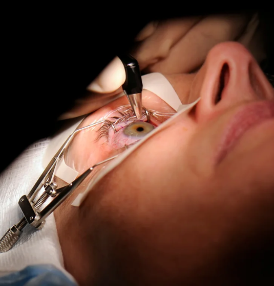 LASIK Eye Surgery