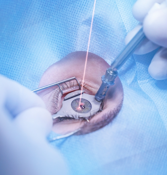 Benefits of LASIK Surgery